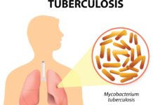 যক্ষ্মা ছাড়াও এ সমস্যার আরও নানা কারণ থাকতে পারে কফের সঙ্গে রক্ত মানেই যক্ষ্মা নয়