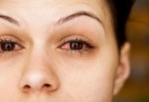 চোখ লাল হলে করণীয়