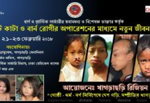 ঠোঁট কাটা-দগ্ধদের চিকিৎসা দেবে খাগড়াছড়ি সেনা রিজিয়ন