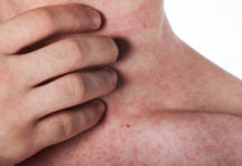 গরমে ঘামাচির যন্ত্রণা