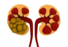 কিডনি স্টোন বের করার অভিনব পথ আবিষ্কার রোগীর!