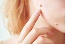 ত্বকের আঁচিলের সমস্যা দূর করবেন যেভাবে